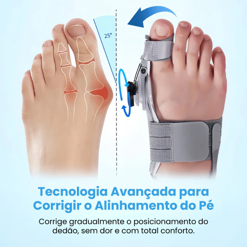 Corretor de Joanete Alinhax – Alívio imediato, correção natural sem cirurgia